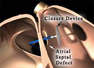 Device Closures for Congenital Heart Defects